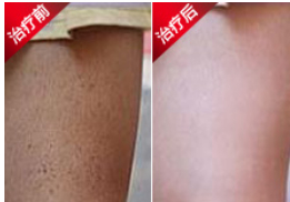 毛周角化治疗前后对比图